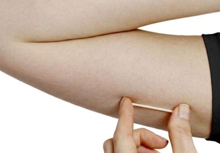 Método contraceptivo Implanon tem duração ampliada para cinco anos